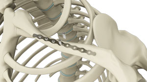 ORIF of Clavicle Fractures