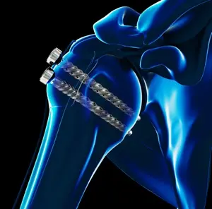 ORIF Proximal Humerus Fracture