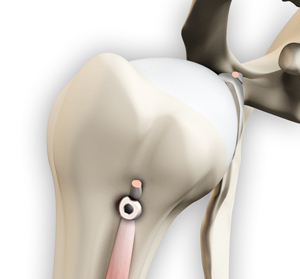 Proximal Biceps Tendonitis