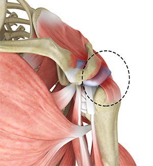 Rotator Cuff Pain img