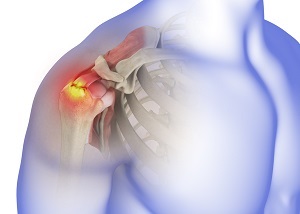 Rotator Cuff Tear img