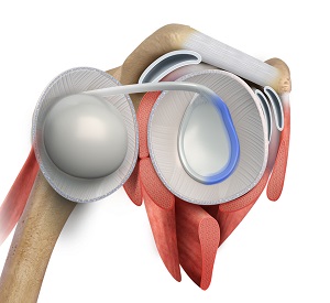 Shoulder Anterior Labral Repair