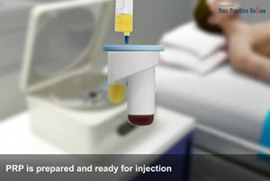 PRP Injection for Joint Pain