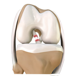 Picture of ACL Injury