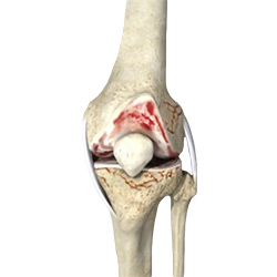 Picture of Inflammatory Arthritis