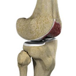 Picture of Arthritis