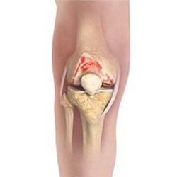 Picture of Knee Osteoarthritis