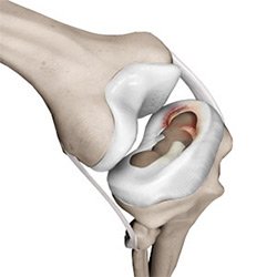 Picture of Meniscus Injury