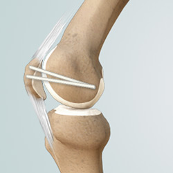 Picture of MPFL Reconstruction