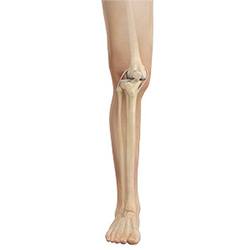 Picture of Patellofemoral Dislocation