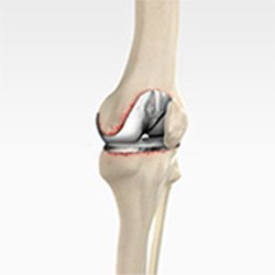 Picture of Revision Knee Replacement Surgery