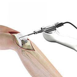 Picture of Robotic Knee Replacement