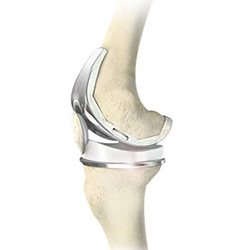 Picture of Total Knee Replacement