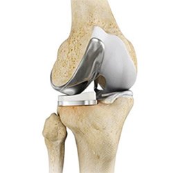 Picture of Unicompartmental Knee Replacement