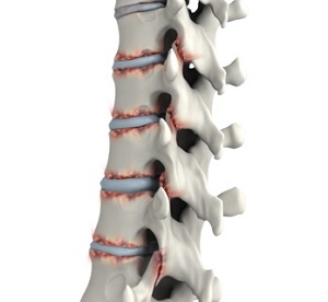 Ankylosing Spondylitis pic