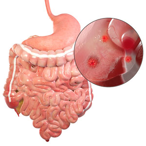 Enteropathic Arthritis pic