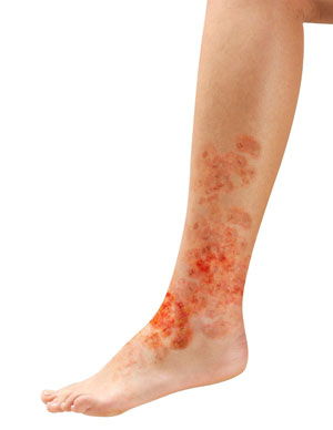 Lupus pic