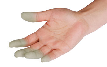Mixed Connective Tissue Disease pic