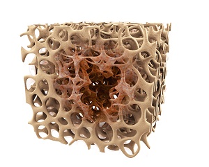 Osteoporosis pic