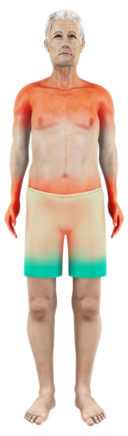 Polymyalgia Rheumatica pic