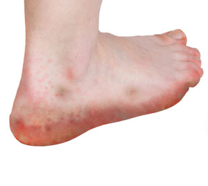 Reactive Arthritis pic