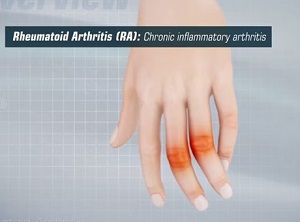 Rheumatoid Arthritis pic