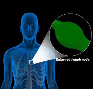 Sarcoidosis pic