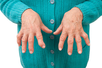 Scleroderma pic