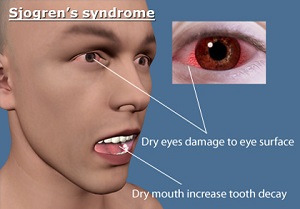 Sjogren's Disease 1