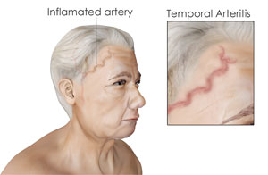 Giant Cell Arteritis pic