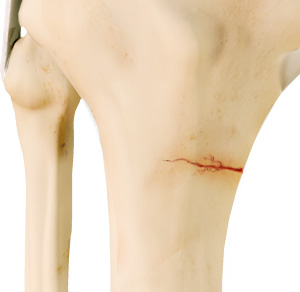 Knee Stress img
