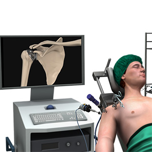 Minimally Invasive Shoudler Joint Replacement img