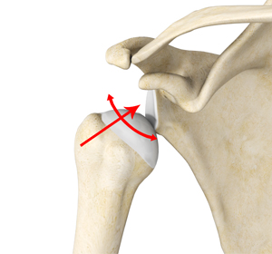 Multidirectional Instability of the Shoulder img