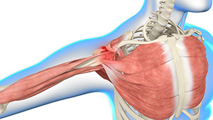 Shoulder impingement img