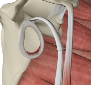 Shoulder Labrum Tear img