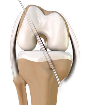 ACL Reconstruction pic