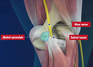 Cubital Tunnel Syndrome (Ulnar Nerve Entrapment) pic