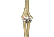 Elbow Arthritis pic