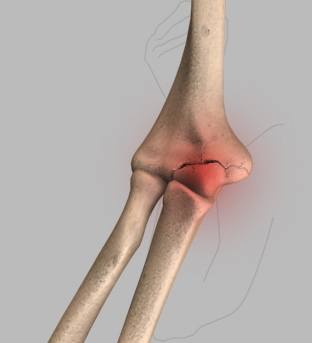 Elbow Injuries pic