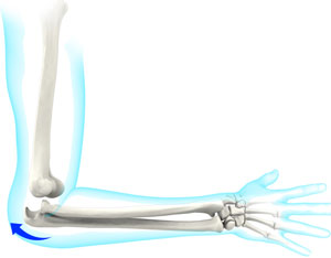 Elbow Instability pic