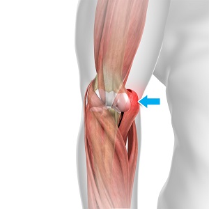 Golfer's Elbow