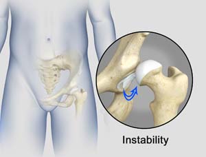 Hip Instability pic