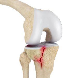 Knee Fracture Surgery pic