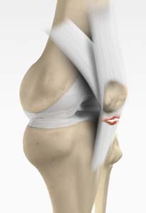 Patellar Tendon Repair pic