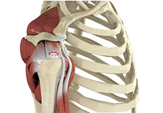 Rotator Cuff Tear pic
