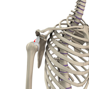 Shoulder Dislocation pic
