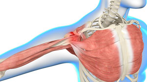 Shoulder Impingement pic