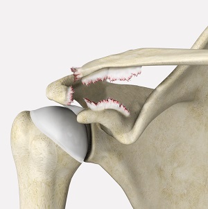 Shoulder Ligament Injuries pic