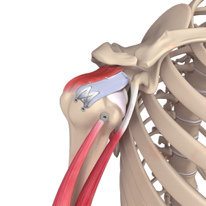 Shoulder Reconstruction Surgery pic