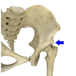 Subspine Impingement pic